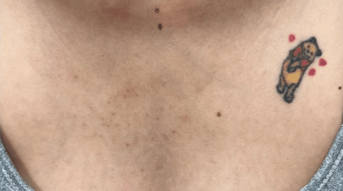 IPL redness treatment before and after - after