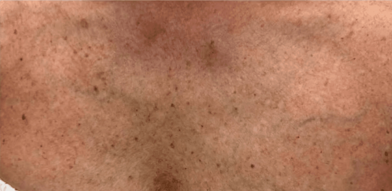 IPL skin renewal before and after - before