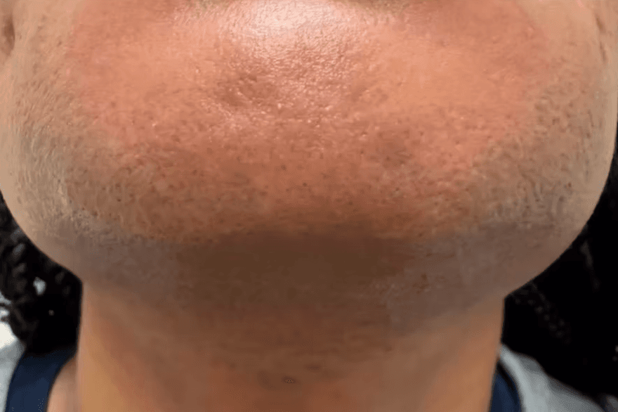 Laser hair removal before and after — second example - after