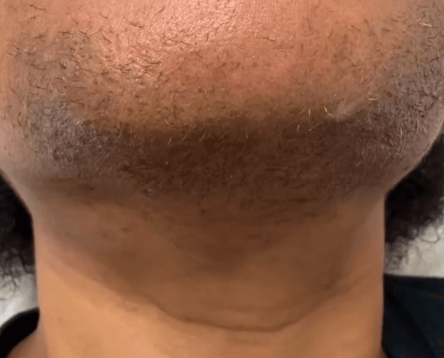 Laser hair removal before and after — second example - before