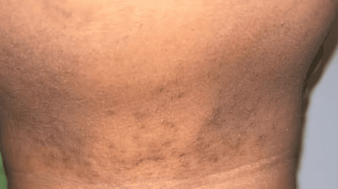 Laser hair removal before and after - after