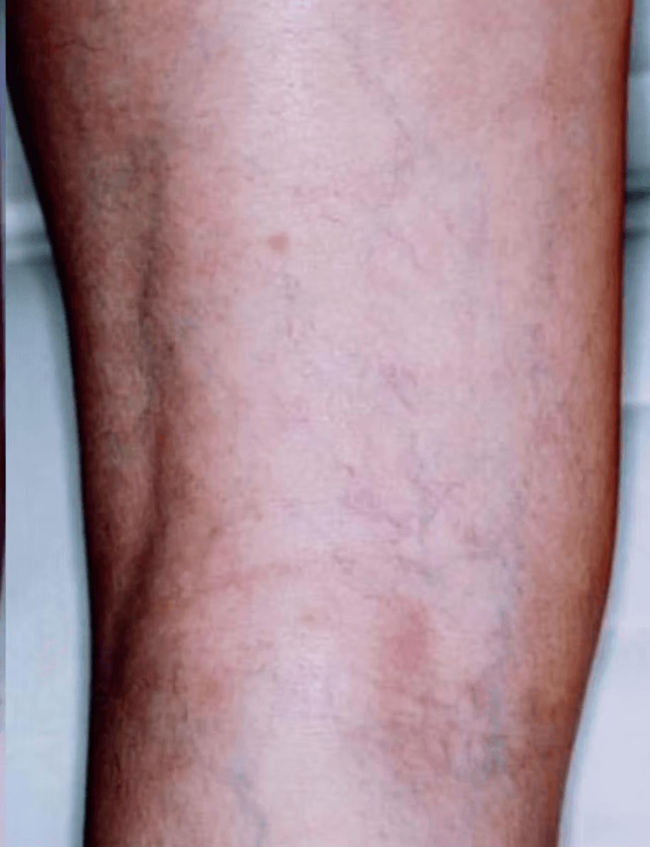 Leg vein removal before and after - after