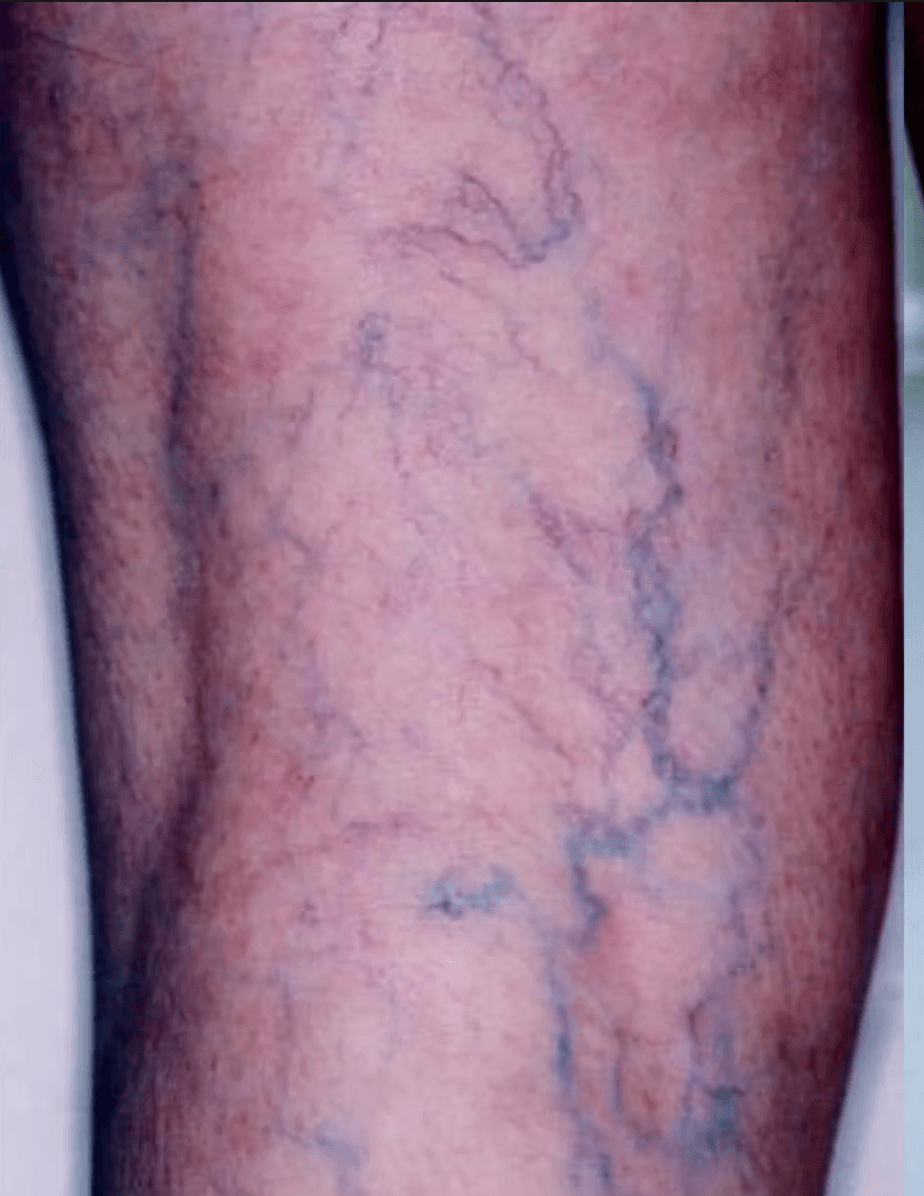 Leg vein removal before and after - before