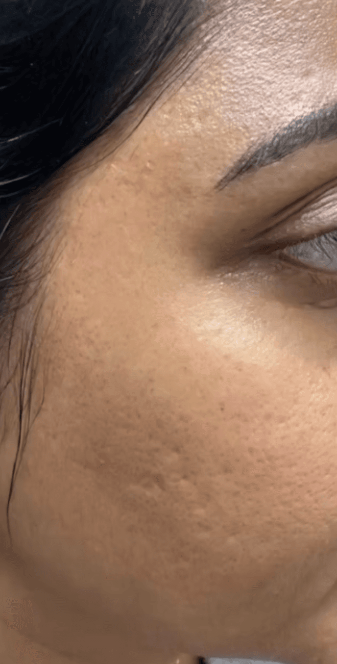 Laser skin resurfacing before and after - before